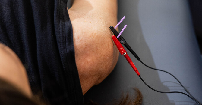 Functional Dry Needling vs. Acupuncture: What’s the Difference and How Does It Help Muscle Pain?